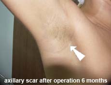 plastic-surgery-breast-augmentation 